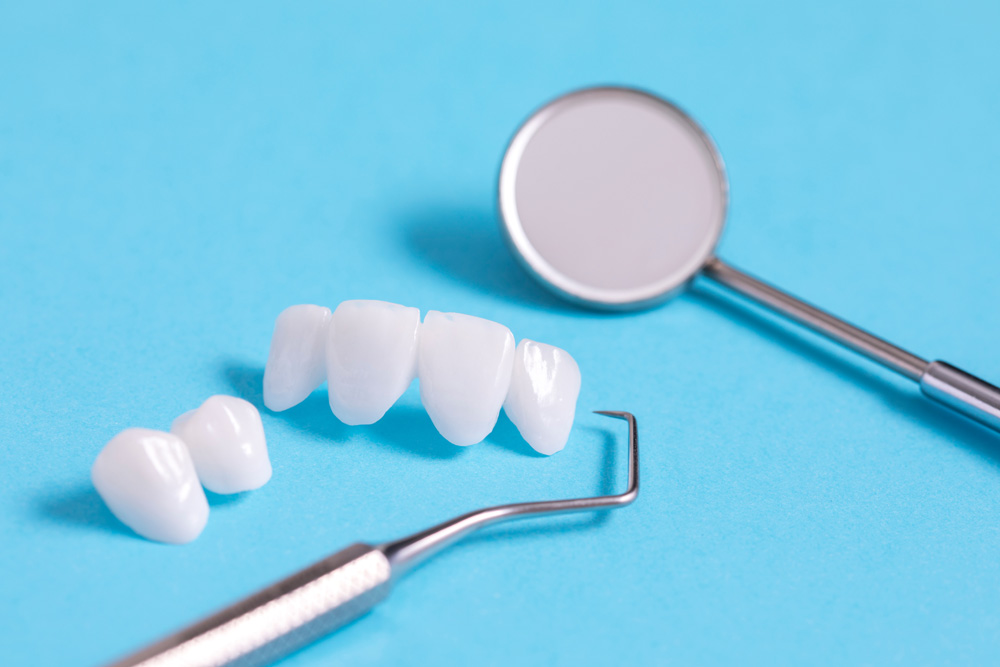 A Step-by-Step Guide to Getting Dental Veneers