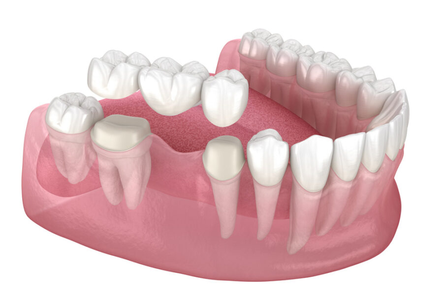 Dental bridge of 3 teeth over molar and premolar