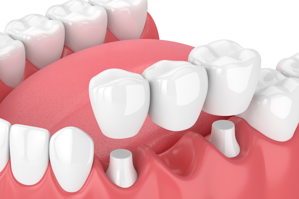 The Benefits of Dental Bridges for Missing Teeth